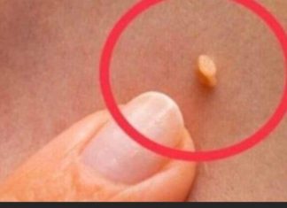 NADALEKO PRIZNATI NARODNI LIJEK ZA LIJEČENJE BRADAVICA JE NITKO DRUGI DO TRAVA RUSA