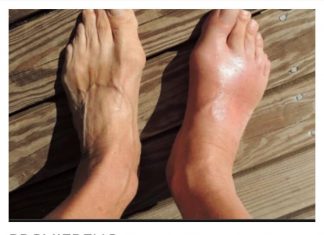 IZBACITE MOKRAĆNU KISELINU IZ TIJELA: Ovo su 3 narodna lijeka za giht koja provjereno djeluju (RECEPT)