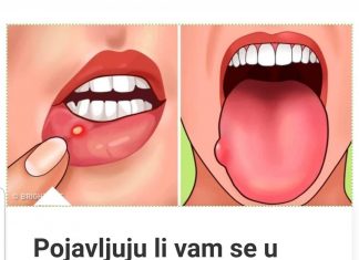 POJAVLJUJU LI VAM SE U USTIMA OVAKVE RANE? EVO ŠTA VAM ORGANIZAM PORUČUJE: ODMAH MORATE URADITI OVO!