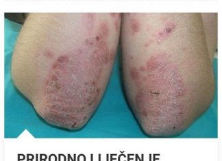 PRIRODNI LIJEKOVI ZA PSORIJAZU: BILJNE MJEŠAVINE MELEMA I ČAJEVA