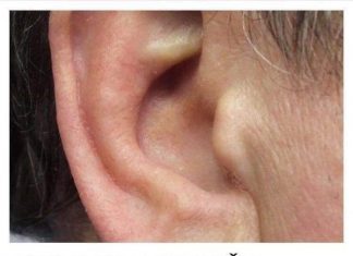 KAKO SIGURNO UKLONITI UŠNI VOSAK: METODE PREPORUČENE OD PEDIJATRA DR. GILA