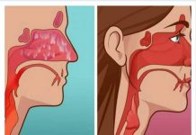 ZA SAMO 10 DANA POTPUNO OČISTITE SINUSE OD GNOJA I SLUZI: Napravite smjesu i privijte oblog (RECEPT)