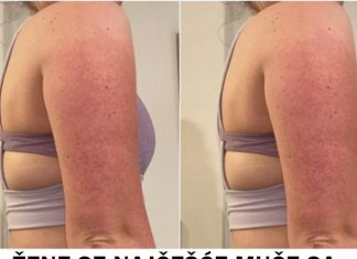 “Pureća Koža” – Uzroci, Simptomi i Mogućnosti Tretmana