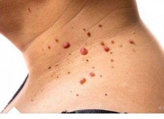 Kažite ZBOGOM PAPILOMIMA U SAMO 1. POTEZU: Ovu namirnicu imate kod kuće, PREPORUČUJU JE I DOKTORI