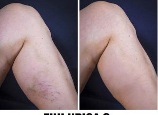 Duboka venska tromboza – neliječena, može imati fatalan ishod! Evo koji su simptomi!