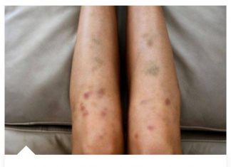 Pojavile Su Vam Se Modrice Na Tijelu Bez Razloga: EVO ŠTA ONE MOGU ZNAČITI,NE IGNORIŠITE!!!