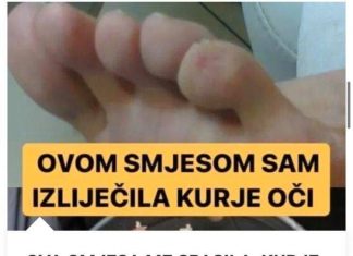 Ova Smjesa Me Spasila: Kurje Oko Nestalo u 2 Dana – Probajte i Nećete Se Pokajati (RECEPT)