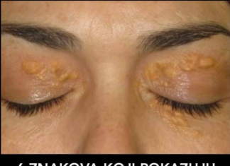 6 ZNAKOVA VISOKOG HOLESTEROLA KOJE NE TREBA ZANEMARITI: Mnogi Ignorišu Ove Simptome, A Mogu Biti Opasni