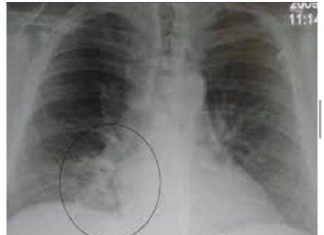 OVA SMJESA JAČA IMUNITET, LIJEČI PLUĆA, DJELUJE PROTIVUPALNO: Trebaju Vam SAMO 3 SASTOJKA