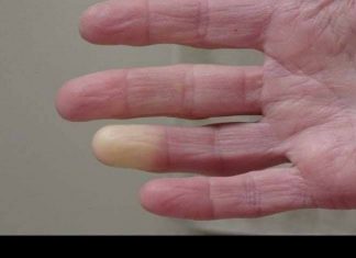 RUKE I NOGE SU VAM STALNO HLADNE, A NIJE CIRKULACIJA? Evo Od Čega Bolujte, ODMAH REAGUJTE!