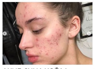 AKNE, SUHA KOŽA I OPADANJE KOSE: Ako imate ove simptome fali vam važan mineral – evo koje namirnice obavezno da jedete