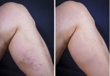 TIHI UBICA S PREDUMIŠLJAJEM: Duboka venska tromboza, neliječena, može da ima i FATALAN ISHOD! Evo koji su simptomi!