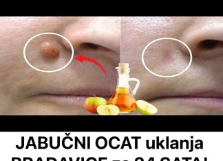 JABUČNI OCAT uklanja BRADAVICE za 24 SATA! Samo napravite ovo!