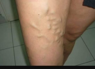 UKLONITE CELULIT I PROŠIRENE VENE, KOŽA ĆE BITI ZATEGNUTA KROZ NEKOLIKO DANA: Ovo Ulje Je Pravo Čudo (RECEPT)