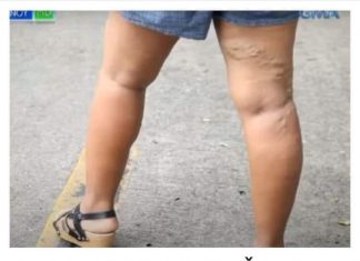 PRIRODNI MELEM ČINI ČUDA: Sa ova 3 sastojka vaše proširene vene će nestati preko noći!