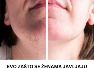 Zašto ženama rastu dlačice na bradi: Evo na kojih 6 zdravstvenih problema mogu da ukažu!
