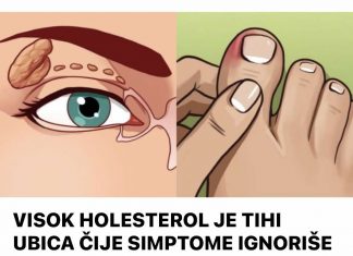 VISOK HOLESTEROL JE TIHI UBICA ČIJE SIMPTOME IGNORIŠE 96% LJUDI. Ovi simptomi će vam spasiti život. br. 4 je posljednje upozorenje