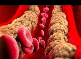 Ovo su znakovi koji upućuju da je vaš holesterol visok