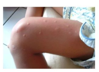 KOMARCI VAM PRAVE PAKAO OD ŽIVOTA? Samo isijecite OVO VOĆE na pola i ostavite u sobi, VIŠE IH NIKADA NEĆETE VIDJETI BLIZU!