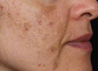 Evo kako da sa ovim jednostavnim trikom od 2 sastojka izbrišete mrlje s kože!