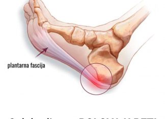 Šta je plantarni fascitis petni trn