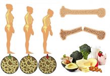 Osteoporoza kostiju simptomi i prirodno lečenje