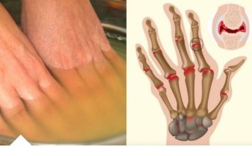 Bolovi u zglobovima ruku i nogu simptomi i lečenje