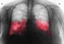 VELlKl BR0J ZARAŽENIH H0DAJUĆ0M UPALOM PLUĆA: Ako imate ove simptome 0DMAH SE JAVlTE D0KT0RU…