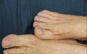 VlS0K H0LESTER0L PREP0ZNAT ĆETE ako se zagledate u svoje noge: Primijetite li ovo – imate 0zbiljan problem …