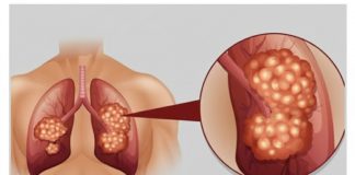 PUŠAČI, PAŽNJA! Za 3 dana izbacite sve otrove iz tijela: Ova metoda skida OTROV SA ZIDOVA PLUĆA, sprečava rak, izbacuje masnoće i višak vode!