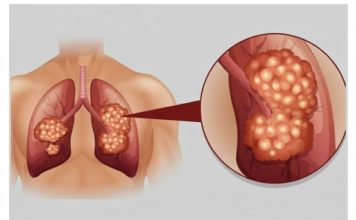 PUŠAČI, PAŽNJA! Za 3 dana izbacite sve otrove iz tijela: Ova metoda skida OTROV SA ZIDOVA PLUĆA, sprečava rak, izbacuje masnoće i višak vode!