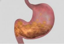 Prirodni pristup ublažavanju gastritisa i bolova u želucu