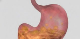 Prirodni pristup ublažavanju gastritisa i bolova u želucu