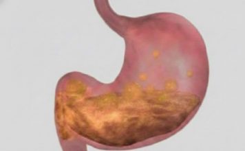 Prirodni pristup ublažavanju gastritisa i bolova u želucu