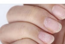 ZNAK ZA UZBUNU: Ako vidite OVO na vašim noktima idite doktoru odmah!