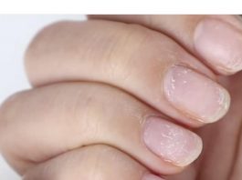 ZNAK ZA UZBUNU: Ako vidite OVO na vašim noktima idite doktoru odmah!