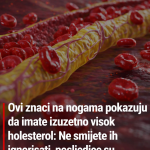 Ovi znaci na nogama pokazuju da imate izuzetno visok holesterol: Ne smijete ih ignorisati, posljedice su fatalne po tijelo