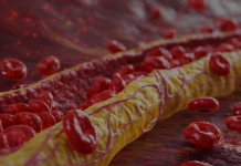 Ovi znaci na nogama pokazuju da imate izuzetno visok holesterol: Ne smijete ih ignorisati, posljedice su fatalne po tijelo