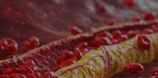 Ovi znaci na nogama pokazuju da imate izuzetno visok holesterol: Ne smijete ih ignorisati, posljedice su fatalne po tijelo