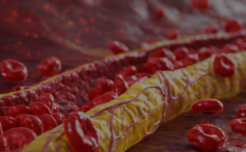 Ovi znaci na nogama pokazuju da imate izuzetno visok holesterol: Ne smijete ih ignorisati, posljedice su fatalne po tijelo