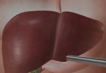 Jetra pod pritiskom: namirnice koje je opterećuju gotovo kao alkohol