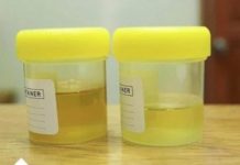 OSJETlTE Ll JAK MlRlS URlNA? To nije infekcija urinarnog trakta, već mnogo opasnije stanje koje IMATE…