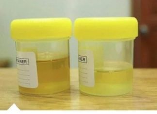 OSJETlTE Ll JAK MlRlS URlNA? To nije infekcija urinarnog trakta, već mnogo opasnije stanje koje IMATE…