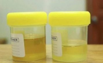 OSJETlTE Ll JAK MlRlS URlNA? To nije infekcija urinarnog trakta, već mnogo opasnije stanje koje IMATE…