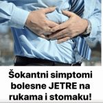 Šokantni simptomi bolesne JETRE na rukama i stomaku