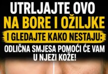 UTRLJAJTE OVO NA BORE I OŽILJKE I GLEDAJTE KAKO NESTAJU: Odlična smjesa pomoći će vam u njezi kože!